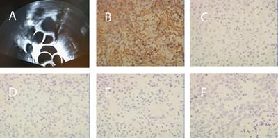 Follicle-Stimulating Hormone-Secreting Pituitary Adenoma Inducing Spontaneous Ovarian Hyperstimulation Syndrome, Treatment Using In Vitro Fertilization and Embryo Transfer: A Case Report